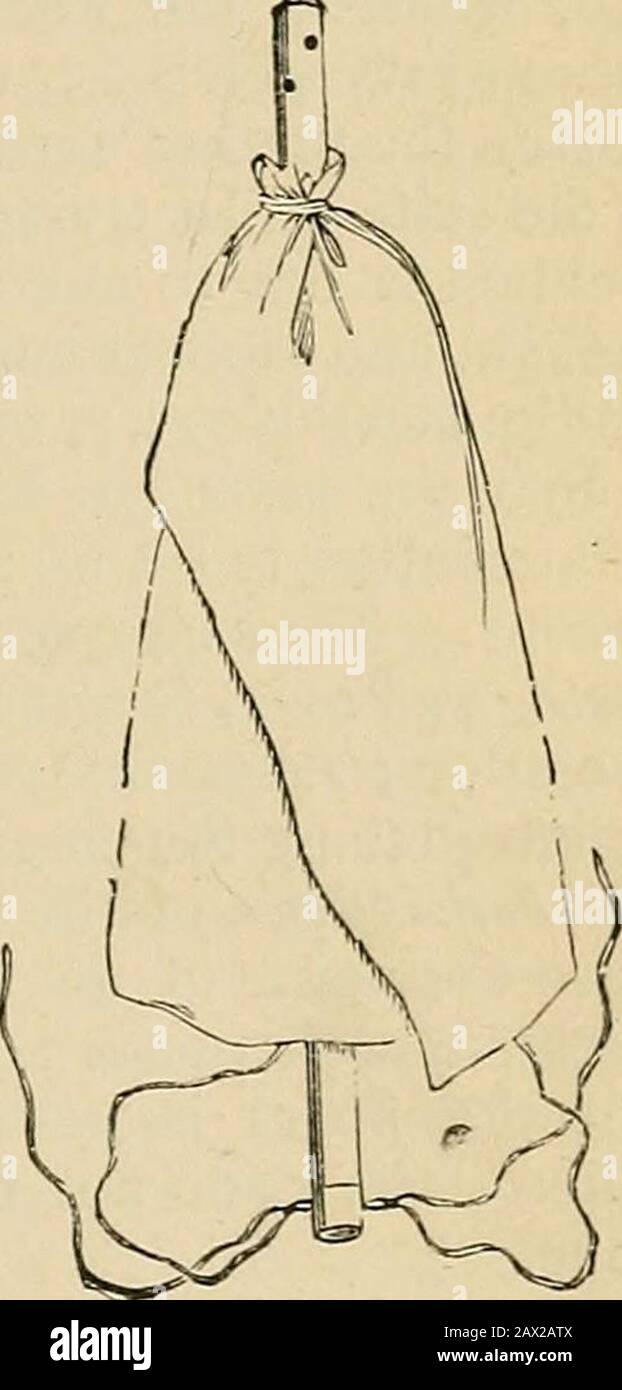 Chirurgie; seine Theorie und Praxis . Kind, und schicken Sie ihn so schnell wie möglich zurück. Wenn es sich um eine Blutung handelt, binden Sie alle Blutungen, die Sie sehen, oder wenn das Blut aus dem tiefen Teil der Wunde kommt, in den versteinerten Schlauch (Abb. 336), und achten Sie darauf, dass das Ende isin der Blase ist, indem Sie Wasser injizieren und eine Sonde durch die Blase führen. Dann mit Stripsof Flusen zwischen dem Petticoat und dem Rohr fest rund einstecken. Im Guys Hospital wird die laterale Lithotomie an einem Geradliniepersonal durchgeführt, durch die Operation Keys, die als Keys bezeichnet wird, WIRD EINE gute Beschreibung der Methode in der Bryants Surgery gefunden. Die si7-uc Stockfoto