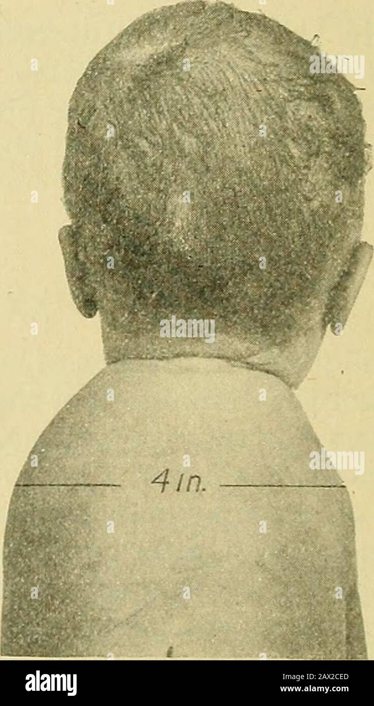 Die Praxis der Geburtshilfe, die für den Gebrauch von Studenten und Ärzten der Medizin entwickelt wurde. Abb. 1165.-Kater des Fetus vor der Clei-dotomie. Abb. 1166. -Fetalkadaver nach der Clei-Dotomie. Bedienung.-Diese Funktion wird am besten mit der gebogenen geburtshilflichen Schere (Abb. 1158) durchgeführt, wobei zwei Finger der linken Hand verwendet werden, um die stumpfen Punkte auf das jeweilige Schlüsselbein zu führen. Es ist in der Regel erforderlich, den Fetalkopf stark zu verlängern oder zu fex, um Platz für die Verwendung der Schere zu bieten. (Abb. 1164.) AUSDRUCK DES FÖTUS. 963 XXIII. SPONDYLOTOMY. Spondylotomie ist eine Operation zur Aufteilung des sp Stockfoto