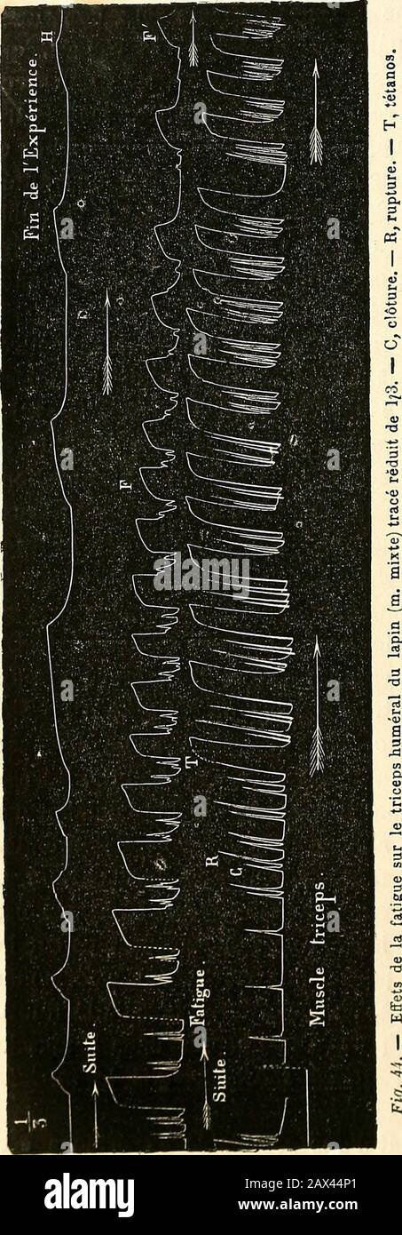 LeÃ§ons d'Anatomie GÃ©nÃ©rale sur le systÃ¨me musculaire. ©que parce que lamplitude est extrÃªme au dÃ©aber, et que lestyle Ã©crivant dÃ©crit, dans les appareils enregistreurs, unarc de cercle autour de son Centre de mouvement. DemÃªme la dÃ©contraction est brusque et instantanÃ©e Ã la tindu tÃ©tanos. En un mot, le muscle mixte agit au dÃ©butcomme un 7nuscle blanc. Mais poursuivons lexpÃ©rience:de F Ã F la Fatigue comparine Ã se faire sentir, les se-cosses de clÃ'ture disparaissent, le tÃ©tanos concernes Ã prendre une concentrion courbe et une dÃ©contraktion lente.Il revÃªt peu Ã peu la forme du Stockfoto