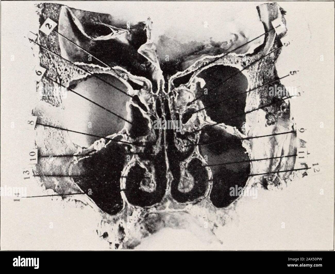 Nationale Eklektische Ärztekammer vierteljährlich . Platte VII-Querteil des Kopfes, von vorne gesehen, gerade hinter dem orbitalen Rand: 1-Links-Stirnhöhlen; 2-Rechts-Stirnhöhlen; 3-Nasenscheidewand; 4-Rechter achrymonasaler Kanal; 5-Sporn auf der rechten Seite des Septums; 6-Anterior-links-inferior-Turbinat; 7-Rechts-Maxillarsinus. Platte VIII.-Querschnittshinter VII, von hinten gesehen: 1, 2, Izellen; 7-Ethmoidal Bulla; 8-Middlebinates; 11-Rechter unterer Turbinatkopf, 3-Viertel Zoll .., 1, .&gt; G-Posterior ethmoidal meatus; 9, 10-Mitte 12-Rechts inferior meatus; 13-inferior Stockfoto