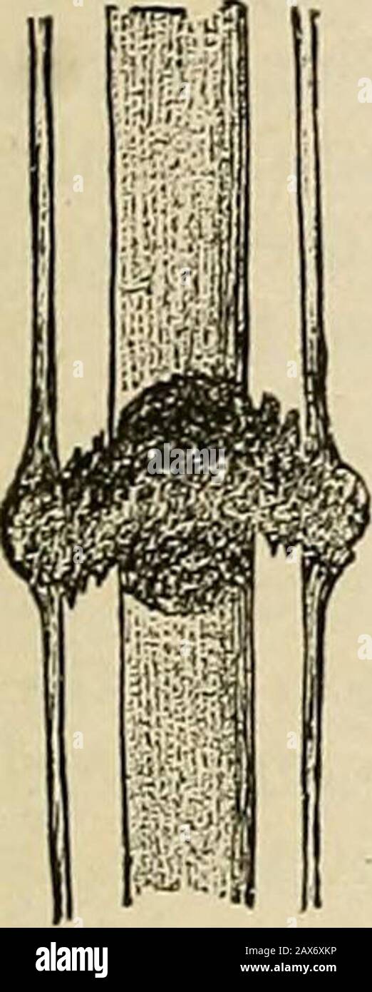 Chirurgie, Theorie und Praxis um die Bruchstücke herum (Abb. 44). Dann folgt schnell eine einfache traumatische Entzündung; das Periosteum und die angrenzenden Weichgewebe werden zusammen mit themedulla mit Leukozyten infiltriert, die sich aus den Gefäßen des entzündeten Periostems, Medulla und Knochens auswachsen und Gewebezellen aus diesen Teilen vermehren. Die Theiflation lässt in wenigen Tagen nach und lässt die Bruchstücke in eine Masse aus weichem, rotem, gelatinösem Material {Granulation-Gewebe einbetten), das sich hauptsächlich aus den Leukozyten und proliferatedgeweblichen Zellen, aber nach Ansicht einiger Beobachter, ableitet Stockfoto