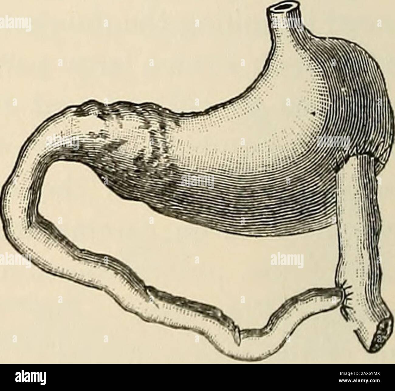 Die Pathologie und chirurgische Behandlung von Tumoren . Abb. 208.-Bildung des Ventils, um den Eintritt von Abb. 209 - Implantation von Duodenum in Jejunummageninhalt in Duodenum (nach Wolfler) und Jejunum in den Magen (nach Wolfler). Gastroenterostomie nach Wolfler.-Wolfler soll verhindern, dass die Galle in den Magen und der Mageninhalt in das Theduodenum eindringen, indem eine Armatur gebildet wird, indem die rechte Hälfte der Öffnung im Darm mit der intakten Magenwand und nur die linke Hälfte mit dem Rand der Öffnung im Magen vereint wird (Abb. 208). Das gleiche OBJEKTKARZINOM. 329 Stockfoto