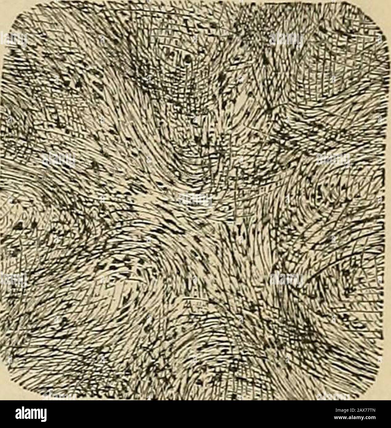 Chirurgie; ihre Theorie und Praxis . : (i) Adenom und B. Das bösartige: (I)Spheriodal-Zelledkarzinom: (A) Hartes, zirrhosiges oder chronisches caj-Cinom, (&lt;5) weiches Enzephaloid oder acu,te-Karzinom und (^) Col-loid-Karzinom. (2) Plattenepitheliom {epitheliom) und (3) Columnarzelliertes oder zylindrisches Karzinofna. III Teratom, eine seltene Form von Tumor, die Knochen, Haare, Zähne oder Bruchstücke der Viscera eines unterdrückten Fötus enthält. L TUMORE DES BINDEGEWEBES. A. Tumore der Art des vollständig gebildeten Bindegewebes. Fibromata oder faserige Tumoren bestehen aus faserigen Geweben, die in der Dichte variieren können Stockfoto