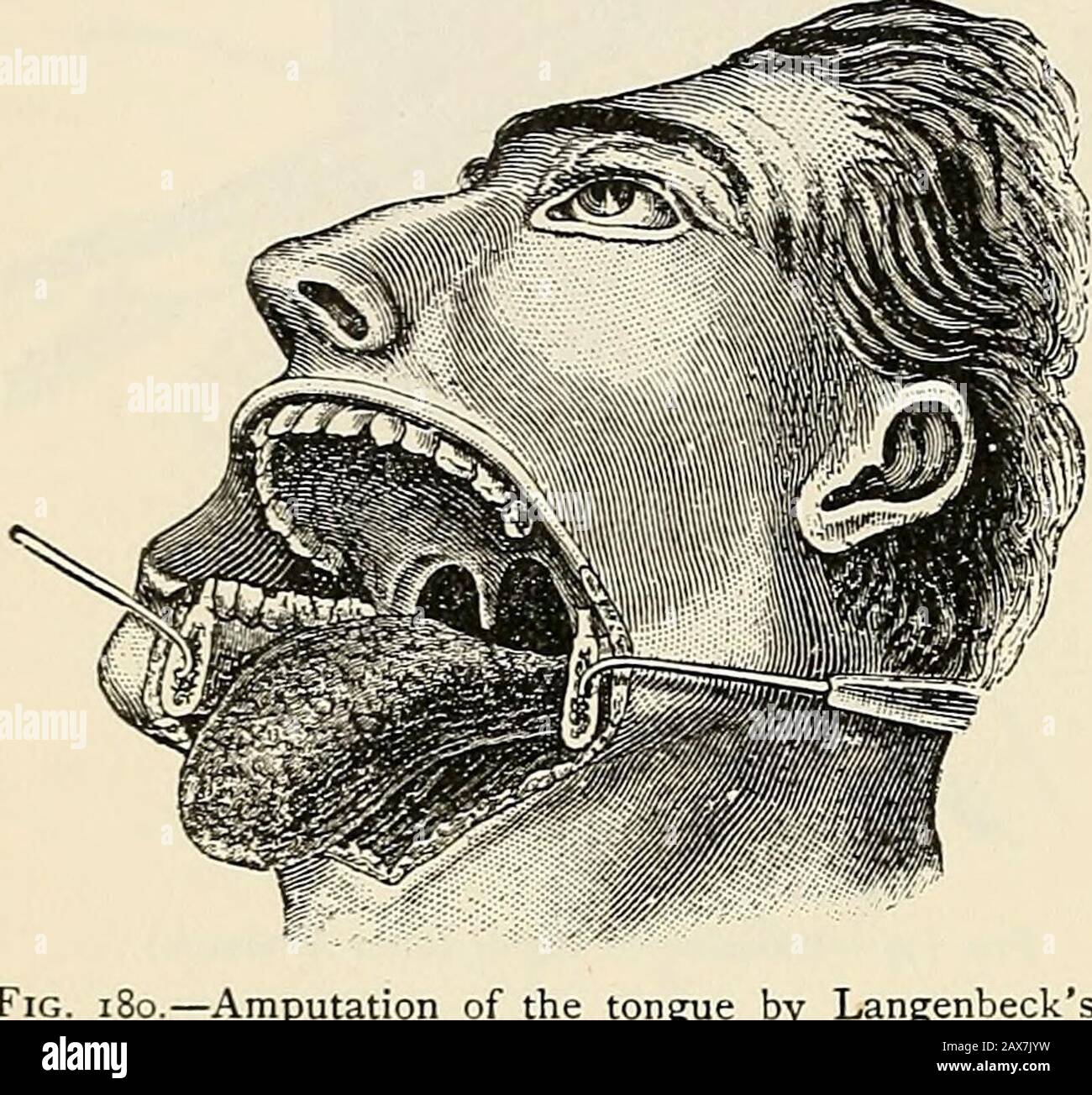 Die Pathologie und chirurgische Behandlung von Tumoren. Egnoli erdachte eine Operation, die später von Billroth modifiziert wurde (Abb. I8i), durch die die Basis der Zunge frei zugänglich gemacht werden kann, ohne die unterste Maxille zu zerteilen. Die Mundhöhle wird durch einen ahorseshoe-förmigen Einschnitt geöffnet, der dem unteren Rand des Kiefers entspricht; die Mundhöhle ist geöffnet, die Zunge wird durch den im Schnitt ausreichend nach vorne gezogen, um sie in Reichweite zu bringen. MORERECent hat Kocher einen Anschnitt entwickelt, durch den die Zungenbasis von Theside aus erreicht wird, ohne den Kiefer zu teilen(Abb. 182). Das i Stockfoto