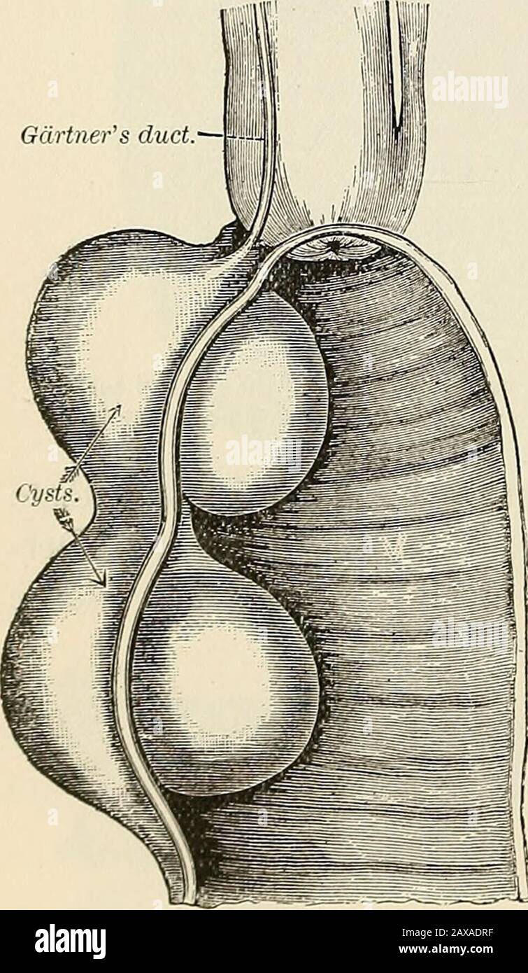 Die Pathologie und chirurgische Behandlung von Tumoren. Unter striktantiseptischen Vorsichtmaßnahmen öffnete sich das Bauchis bis zur erforderlichen Öffnung durch die Linea alba. Nach erneuter Bewegung des Inhalts der Zystindem der Tumor geklopft wird, wird er für-ward in die Wunde gezogen und seine Pedikleis nach der Transfixierung durch eine Doubleligatur aus Seide ligiert, Und die Zyste ist in einem sicheren Abstand von den Liga-Turen, um zu verhindern, dass Blutungen von den Ligaturen abrutschen. Der Stumpf sollte leicht mit Iodoform verstaubt werden, danach wird er in den Bauch verwischt und der äußere Einschnitt wird in der üblichen mA geschlossen Stockfoto