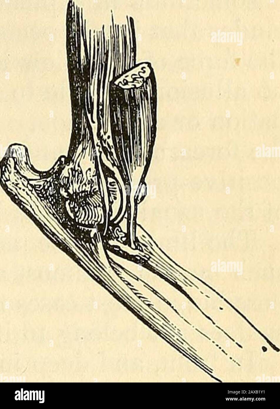 Eine praktische Abhandlung über Brüche und Veruntreuungen . ius und Ulna Rückwärts. Ursachen - In sechsundfünfzig Fällen, die von mir beobachtet wurden, beträgt das Durchschnittsalter etwa zwanzig Jahre; das jüngste ist vier Jahre und das älteste dreiundfünfzig Jahre. Zweiundzwanzig dieser Zahlen traten bei Kindern unter vierzehn Jahren auf. Im Allgemeinen ist die Verunfallung durch einen Sturz auf die Handfläche entstanden, wie wenn beim laufen eine Person nach vorne gefallen ist, während der Unterarm vor dem Körper ausgestreckt ist, oder er kann aus einer Höhe einen Fallenaus haben; Sobald ich es von einem Blasaufnahmebudupon auf der Rückseite und im unteren Teil des Humerus bekannt habe, a Stockfoto