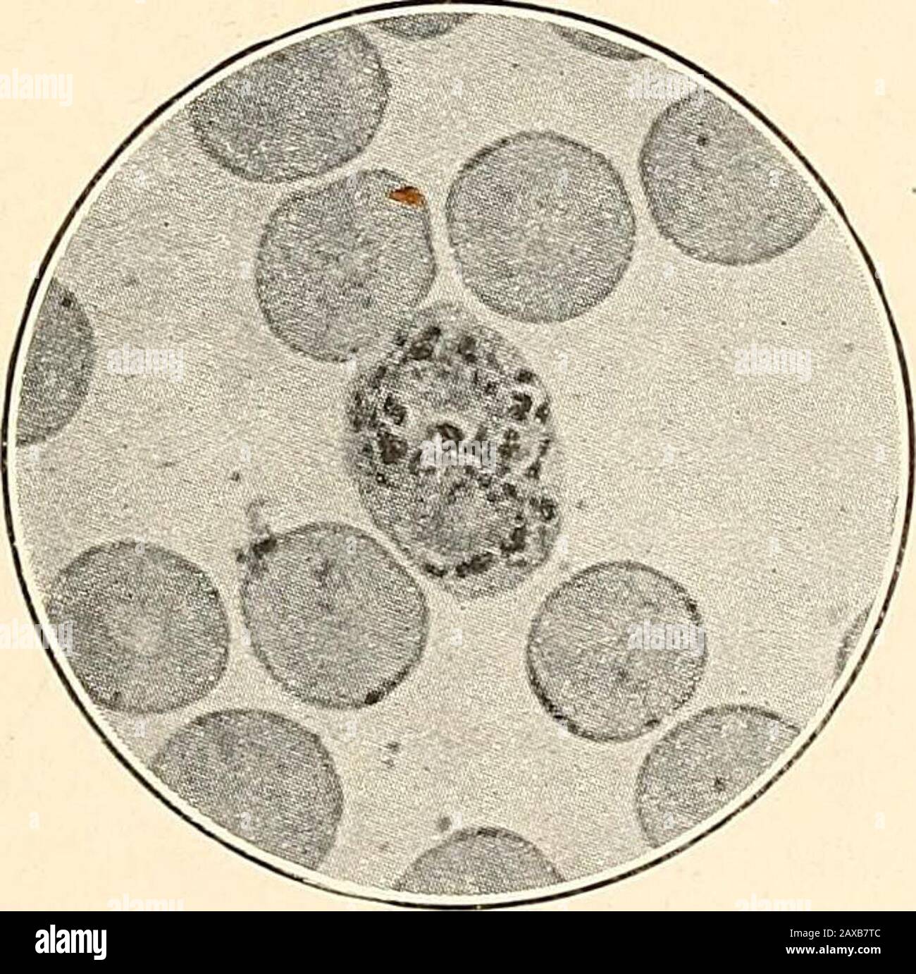 Die Malariafieber, das hämoglobinurische Fieber und das Blutprotozoa des Menschen. Abb. 3.-Plasmodium vivax. (TertianPlasmodium.) Halbgewachsener Parasit.Photomikrograph, X 1200. Abb. 4.-Plasmodium vivax. (TertianPlasmodium.) Presegmentieren para-Site. Photomikrograph, X 1200. Untersuchen. Während die Vergrößerung nicht vor der Pigmentierung des Plasmodiabecoms markiert ist, vergrößert sich die rote Zelle nach der Pigmentierung schnell, und wenn das Plasmodium vollständig entwickelt ist, ist es im Allgemeinen doppelt so groß wie eine nicht in-abgefaste Korpuskel und fast farblos. Bei den gefleckten Exemplaren ist die Vergrößerung sehr auffällig und Stockfoto