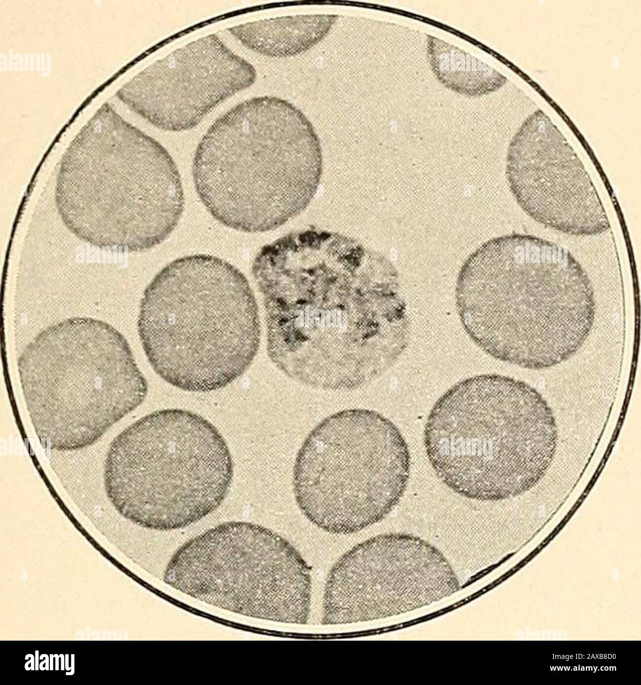 Die Malariafieber, das hämoglobinurische Fieber und die Blutprotozoen des Menschen. Im Menschen und diejenigen, die sich intogamettiert entwickeln, beabsichtigten, die Infektion in der Mücke fortzusetzen. Die zu Schizonten bestimmten Trophozoitesis zeichnen sich durch die Ringform aus, und solche Formen geben immer die Trophozoiten, die Intogameten entwickeln, stark an. Veränderungen in den Infizierten Blutkörperchen - die Veränderungen, die in den mit Plasmodium vivax infizierten roten Blutkörperchen auftreten, sind diagnostisch gesehen von großer Imporanz, da diese Veränderungen allein ausreichen, um dieses Plasmodium von e zu differenzieren Stockfoto