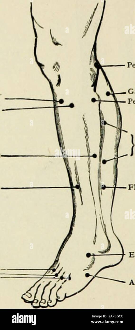 Eine Abhandlung über die Nervenkrankheiten von Kindern, für Ärzte und Studenten . Abb. 27.- Pes Equinus OfEight Jahre Dauer. Tibialis Anticusextensorziffer. Kommun. Longus. Peroneus Brevis Extensor Hallucis Loncus Dorsaler Interossei. Peronealnerv Gastrocnemius (Äußerer Kopf).Peroneus Longus Flexor Hallucis Longus Extensor Digit. Komm Bret.Entführer Minimi Digiti Abb. 28.-Motorpunkte. (Erb.) EINLEITUNG-UNTERSUCHUNGSMETHODEN.Muskeln von Rücken und Rumpf. 33 Name der Normalen Symptome des Innervated Dargestellt, welcher Muskel Muskel ist. Funktion. Mangelhafte Aktion. Im Allgemeinen In-volved. Rector Extens Stockfoto