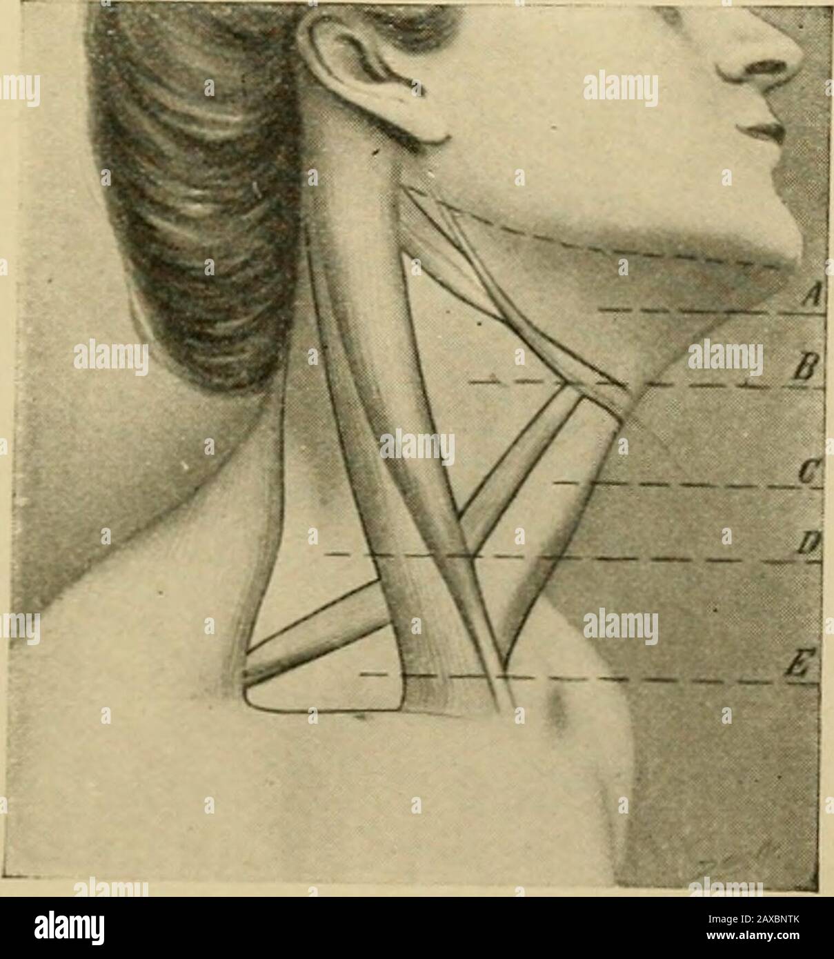 Angewandte Anatomie und Mundchirurgie für Zahnmediziner. Er kann mit einem Unterkiefer und einer Linie, die aus dem Winkel des Mandibleto des Mastoid-Prozesses des Temporalknochens gezogen wird, unten am Schlüsselbein. Die Abdeckungen des Quadrats des Halses sind von der Haut, der oberflächlichen Faszie, in der die Pla-Tysma-Myoide liegen, bis hin zur tiefen Faszie. Der Musculus sternocleidomastoid verläuft diagonallyüber das Quadrat des Halses, von seinem posterioren Vorwinkel bis zu seinem vorderen Unterschenkelwinkel, wobei er in anterior und ein hinteres Dreieck unterteilt wird (Abb. 13). Das vordere Dreieck ist durch den vorderen in drei Kleindreiecke geteilt Stockfoto