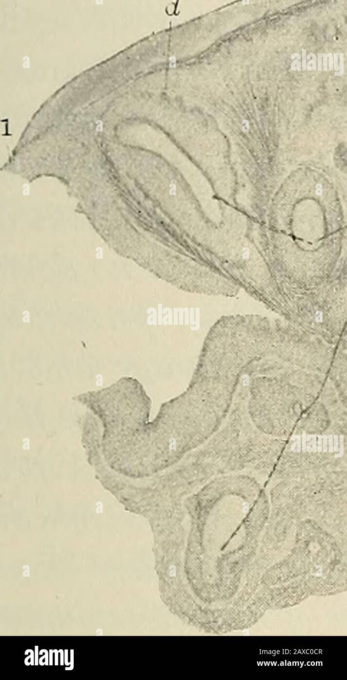 Die Pathologie und chirurgische Behandlung von Tumoren . I. Endotheliom hyalinum aus Kapsel der submaxillaren Drüse (nach Klebs): A, Stroma; B. kleinerer Teil Ofstroma; c, hyaline Substanz; d. Zellen. 2. Micous-Membran aus großem Inte.stine von Schwein; X 350 (nach Klein). Thekapillare Blutgefäße, die in verschiedene Richtungen um die Krypten geschnitten werden, werden mit Karmingelatine injiziert. 3. Avertikaler Abschnitt durch das Epithel, das die Haut bedeckt - Epidermis; X 35 Grad (nach Klein): A, rete Malpighii, orrete mucosum; b, körnige Schicht (Langerhans); c, Stratum lucidum (Schron); d, Stratum corneum. ETIOL Stockfoto