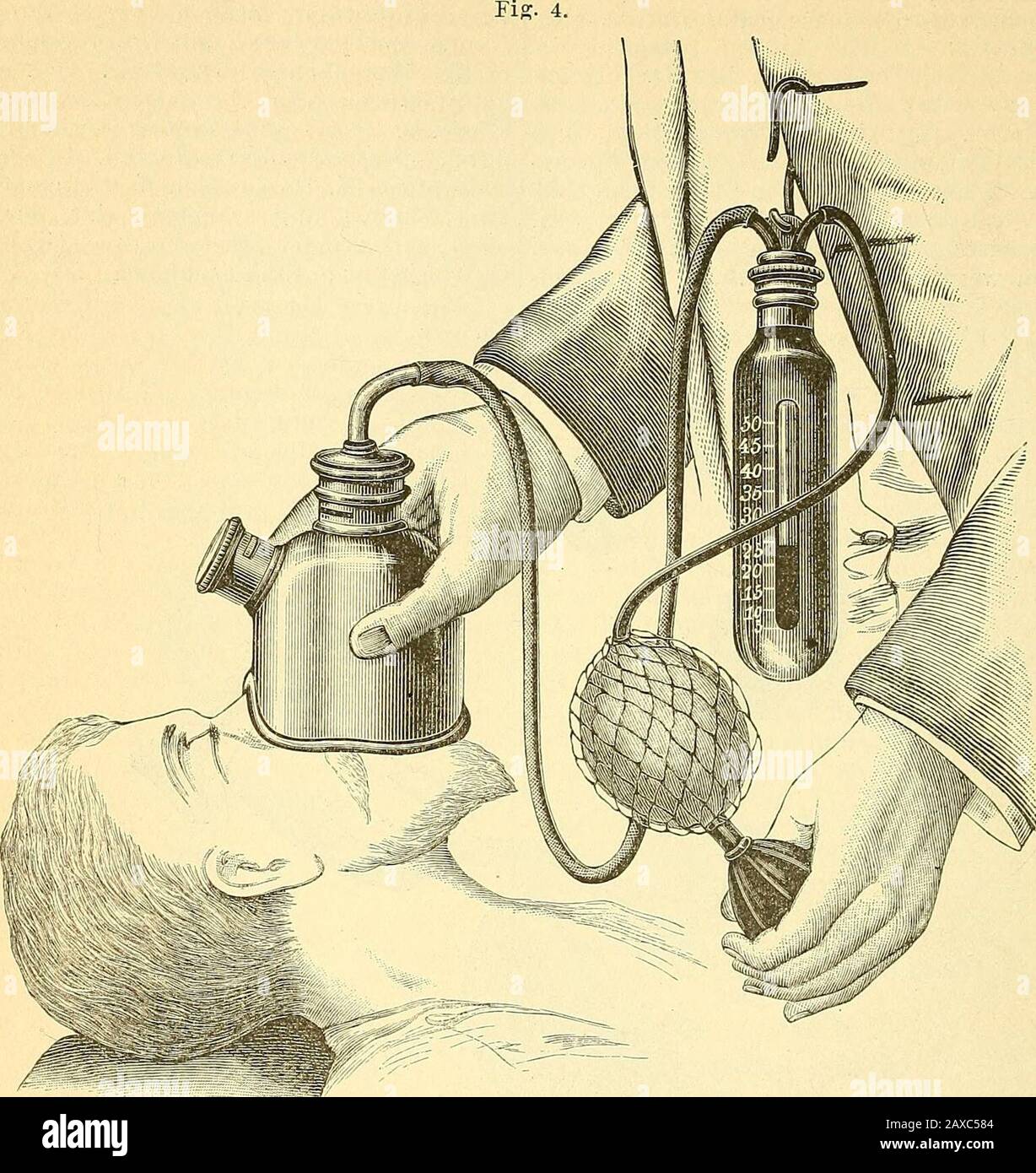 Therapeutisches Lexikon: Für praktische Ärzte. Elchem die Gliedervollkommene erschlafft, die Augenlider leichteglossen, die ßulbi nach oben gekehrt, diePupillen verengt, Puls- und Respirations-frequency verringert sind, die Körtemperaturpernissäule, das blatt. Mit demolständigen Aufhöfen des Cornealreflexes istdie N. eingetreten. Ernüchternd dieser Augenblickkommiss, wird die Chloroformmaske vomGeschichte des Kranken entfern und demselbendie für die Operation erforderliche Lage (s. o.) 36* 1127 NARKOSE. 1128 gegben. - die Aufgaben des NarJcotisirendenbestandes ausser in der Darre Stockfoto