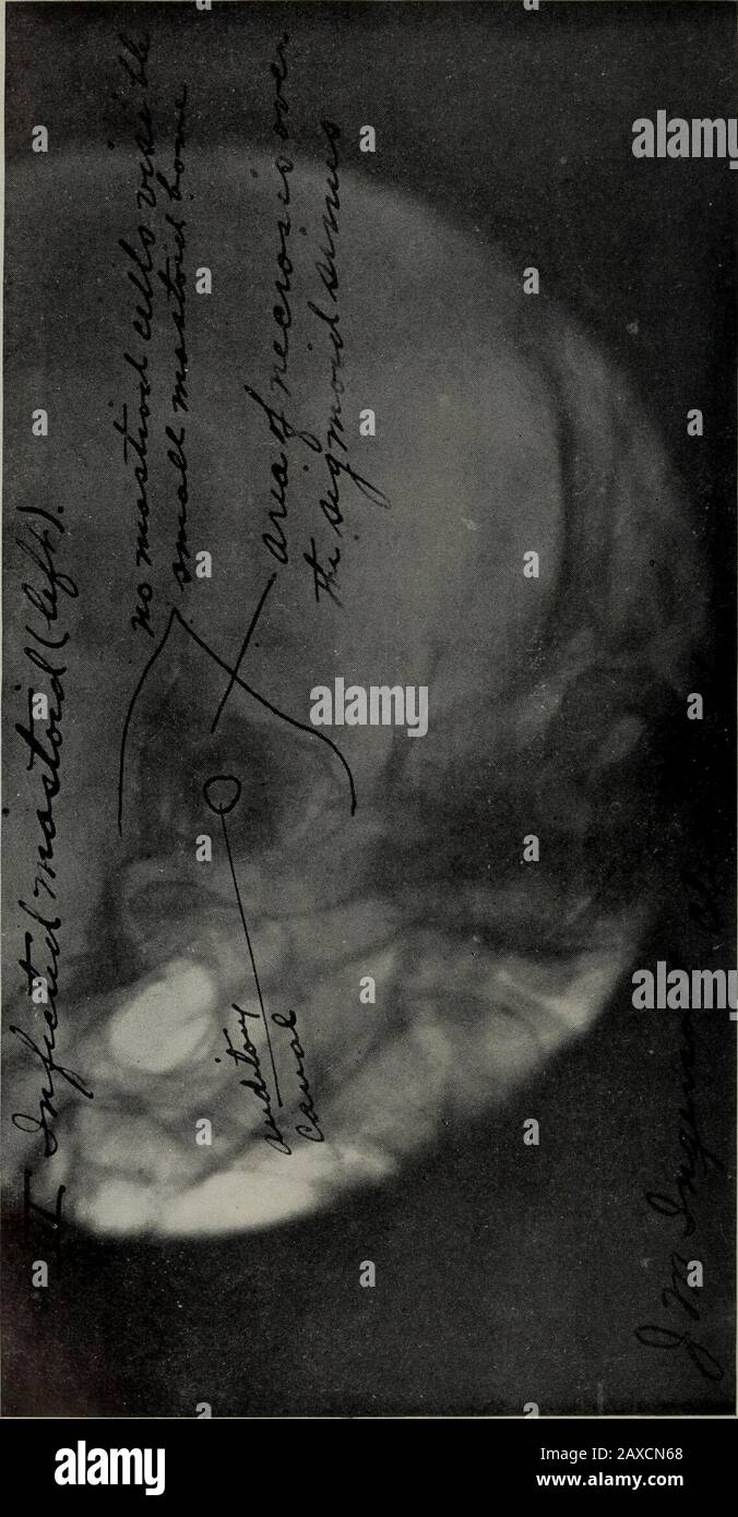 Die medizinische Fachzeitschrift in Cleveland. CO W) 12S o a,o. 12o CO CU a Bo o S Ingersoll-Röntgenbilder in Diagnose der Mastoiditis 597-Posure des Sinus und der Dura und der frühen Operation Probablyverhinderte eine Gehirn- oder Sinusinfektion. Fall III Männlich, 30 Jahre alt. Akute Otitis Media forten Days. Die Entladung aus dem Ohr nimmt allmählich ab. Eine Gran-ulations-Gewebeprojektion durch die Perforation in der Trommelmembran. Einige Schwellungen des hinteren, übergeordneten Teils der dekanalen Wand. Keine Schmerzen im Mastoid. Kein spontaner Nystag-mus. Drehprüfung normal. Temperatur normal. Ein Röntgenbild zeigte, dass alle o Stockfoto