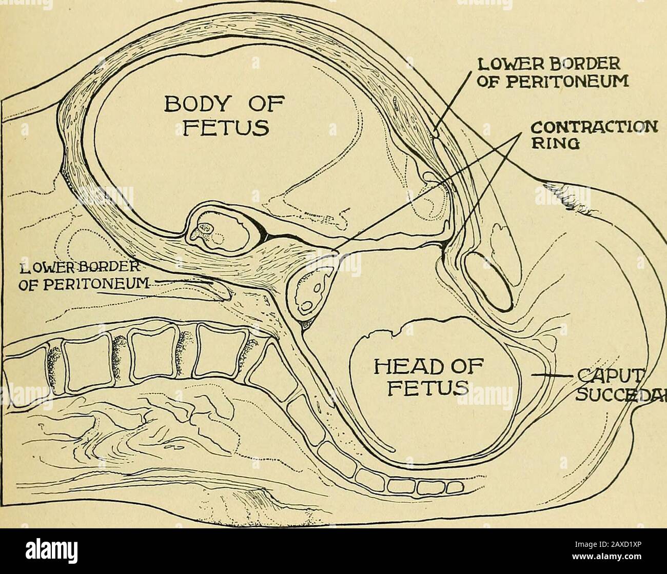 Uterine rupture uterus Fotos und Bildmaterial in hoher Auflösung Alamy