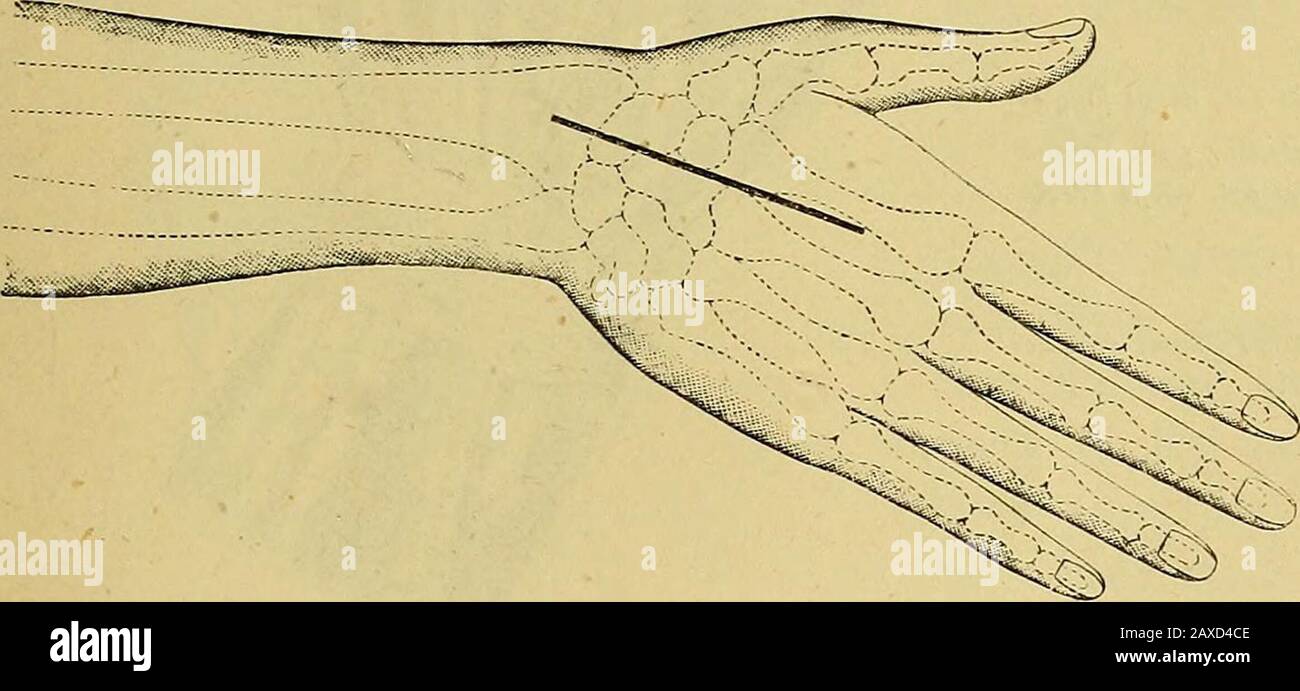 Das Handbuch des Chirurgen zur Behandlung von Kriegsverletzten: Ein Preisaufsatz . 24? Sie zu den Metakarpalknochen, kommunizieren miteinander (Abb. 451).In diesem Fall wird der folgende Vorgang durchgeführt. III VOLLSTÄNDIGE EXZISION DES HANDGELENKS. Mit Langenbecks dorso-radialem Einschnitt. 1. Der Bediener sitzt an einem kleinen Tisch, auf dem die Hand leicht adduziert ist und mit dem Dorsum ganz oben, Einem ihm gegenüber stehenden Assistenten. 2. Ein kutaner Einschnitt, der in der Mitte des Ulnarrandes des Metakarpalknochens des Zeigefingers beginnt, wird 9 cm hoch bis zur Mitte der dorsalen Brandung getragen Stockfoto