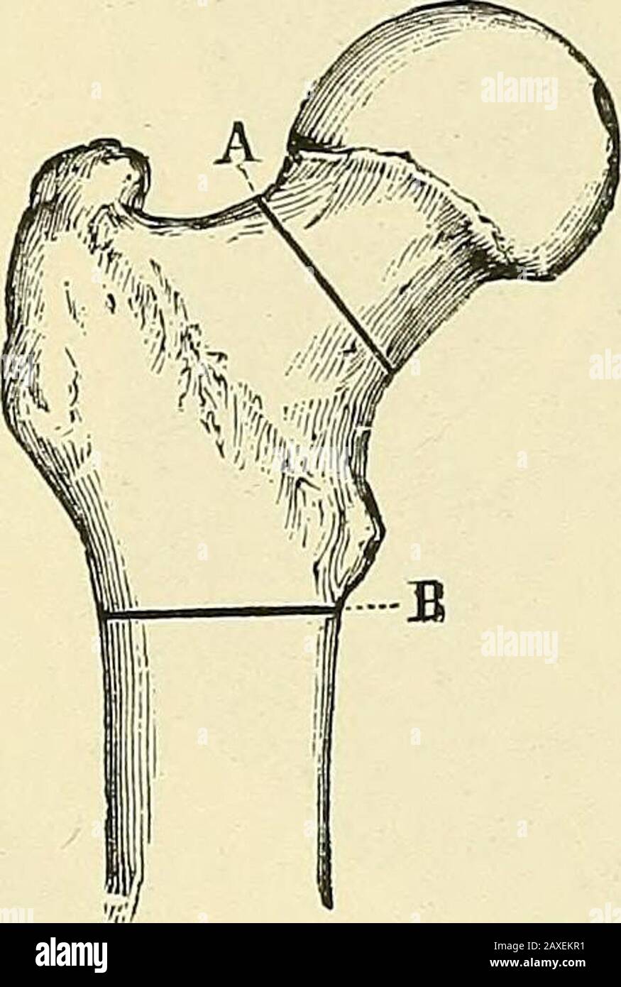 Ein Handbuch der operativen Chirurgie. Teotom durch einen gebogenen Aufzug, der auf der weiteren Seite des Oberschenkelhalses platziert und dort von einem Assistenten gehalten wird. Dies ist besonders ratsam, wenn der Hals von oben, wie direkt unter dem inneren Teil des Kapsuleruns, die Arterie und Vene des inneren Zirkumflex angegriffen wird, was bei einer Verwundung durch einen versehentlichen Schlupf des ChiseLAnother Punktes eine schwere Blutung riskieren würde. Die richtige Schnittrichtung. Es ist leicht, ihn zu schräg zu machen und so den Schaft nach oben zu greifen. Wir haben die ursprüngliche subkutane Operation des späten nicht beschrieben Stockfoto