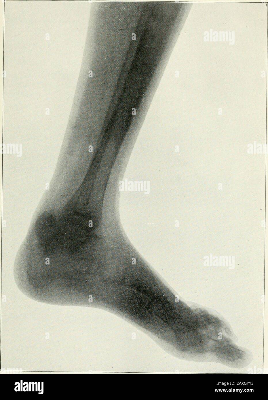 Annalen der Operation . Platte . ll.-Skiagraph zeigt zwei Nadelfragmente in der Hand. Platte III,-Skiagraph zeigt die rückwärtige Verortung des Astragalus. DIE ANWENDUNG VON RÖNTGENSTRAHLEN IN DER CHIRURGIE. 705 sehr deutlich ist die vergleichende Dichte von Haut, Sehne, undmuskulären zu den Röntgenstrahlen, der Raum posteriorly zwischen Thesuperficial und tiefen Muskeln im Bein sehr ausgeprägt. Der Tendo Achilis lässt sich über die trochleäre sur-face des Astragalus bis zu seiner Einfügung im Calcaneum verfolgen, ebenso wie das nach hinten gerichtete Abbohren des posterioren tibialen Tendonsgegenens der unteren tibialen Epiphyse. In Stimsons se Stockfoto