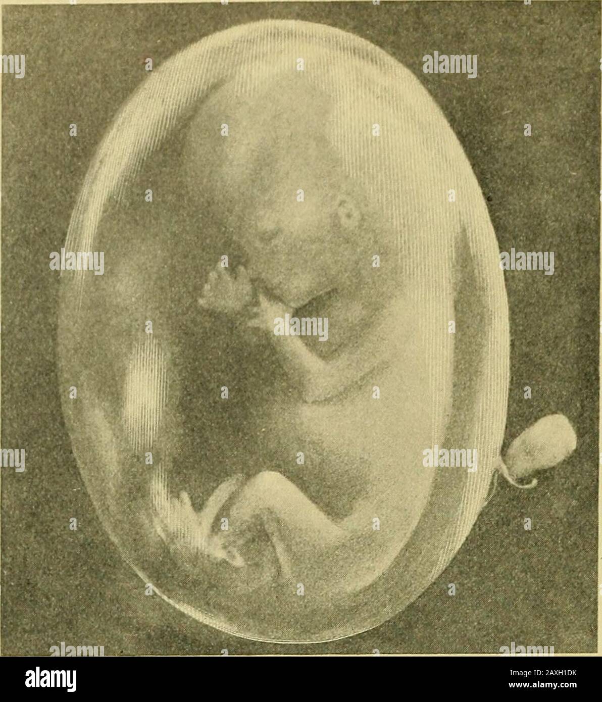 Liquor amnii Fotos und Bildmaterial in hoher Auflösung Alamy