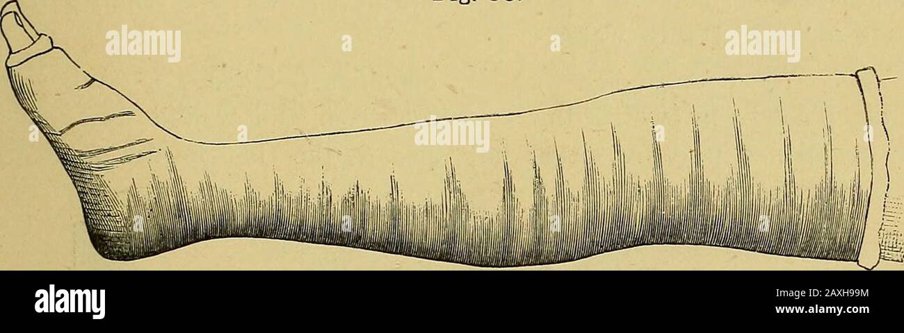 Das Handbuch des Chirurgen zur Behandlung von Kriegsverletzten: Ein Preisaufsatz . WYWODZOFFS-Maschine für Pflaster von Pariser Bandagen. 13. Als Anwendung unter dem Putz von Pariser Bandagen kann Koch-/Buntwäsche geeignet eingesetzt werden, da es das beste Mittel ist, Vorsureund Strangulation abzuwenden (Abb. 80). Abb. 80.. Der Putz von Paris wurde auf Baumwollwolle aufgetragen. 14. Angefeuchtete Gazenbandagen (Roser) oder trockene Flanellwalzen können ebenfalls für den gleichen Zweck in zusammengesetzten Brüchen eingesetzt werden, ebenso wie in Carbolöl getränkte Flanel- oder Gazenbandagen (10 Prozent): Thelatter werden nicht leicht imprägnierter Witz Stockfoto