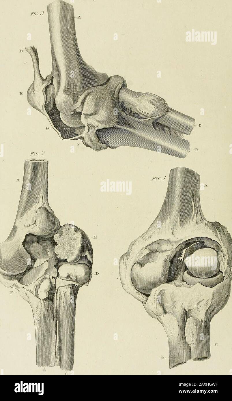 Eine Abhandlung über die Verschiebungen und die Frakturen der Gelenke . FVibKshcd bvibdcT Cooper.i3s: ILTiflnnai /V CJ-Cnnten. PLATTE XXVI. Schews eine Verortung des Radius nach hinten, hinten und zur äußeren Seite des äußeren Kondyls des os hun i. A. Os humeri B. Radius C. Ulna D. Internes Kondyle des os humeri E. Coronoid-Prozesses der Ulna; das kapsuläre Lig-ament wird geöffnet, um D. und E. F. Den Kopf des Radius nach hinten und nach außen hin zu verschachteln G. Das koronare Ligament riss durch. Gegeben von Herrn Poingdestre. Gezeichnet von Herrn Sylvester. MuseuMi St. Thomass Hospital. PL.XXMl, FI& 3. Iiitli; Stockfoto