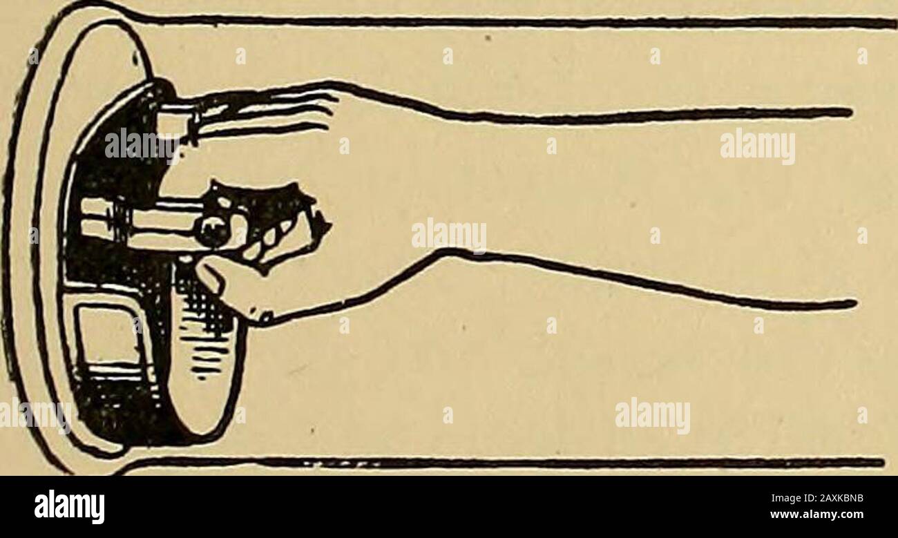 Rationale Therapie. Abbildung 4: Saugnäpfe. Wenn der Grad der Bevacution des Bechers groß ist, weist dies auf eine passive Hyperämie hin. Bier hat den von Junod und seinen Anhängern seit 1834 eingesetzten Apparat wieder eingeführt und modifiziert.Er bestand aus großen Tassen, die aus Glas oder Zinn, Twoin in Form von Stiefeln, für Beine und Füße sowie zwei Zylindern, Forarmen und Händen bestehen. Nachdem die zu behandelnde Extremität in das Gerät eingesetzt wurde, wurden die Öffnungen fest mit einer mit einer Saugpumpe erzeugten Gummi-Manschettensandabsaugung verschlossen. Das Gerät wurde bei der Behandlung einer Reihe von Krankheiten mit dem Ideaof verwendet Stockfoto