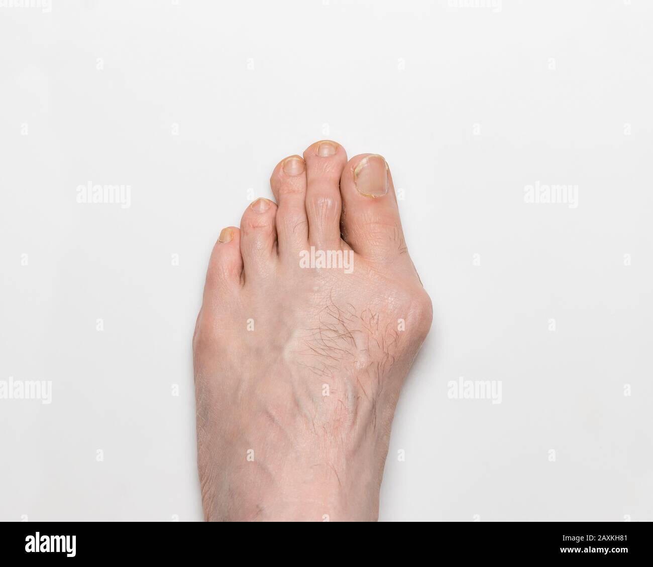 Nahaufnahme des linken, rechten Fußes mit Bunion, Hallux valgus, auf großer Zehe, was zu Deformität führt Stockfoto