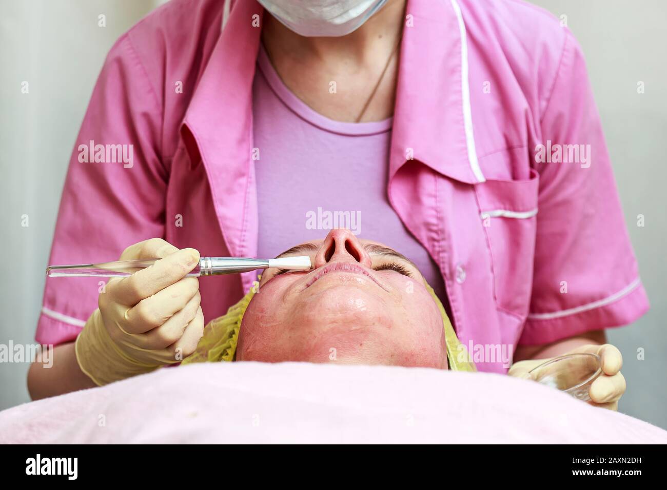 Der Kosmetologe verwendet eine Bürste, um nach dem chemischen Peeling eine beruhigende, transparente Maske auf die gerötete Haut des Gesichts des Patienten aufzutragen. Stockfoto