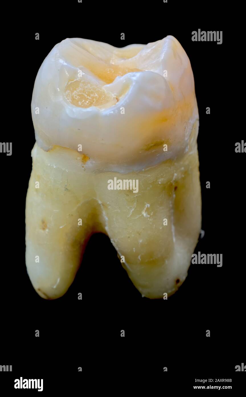 Dies ist eine obere Seitenansicht meines Weisheitszahns, der aufgrund einer massiven Formung in diesem extrahiert werden musste. Stockfoto