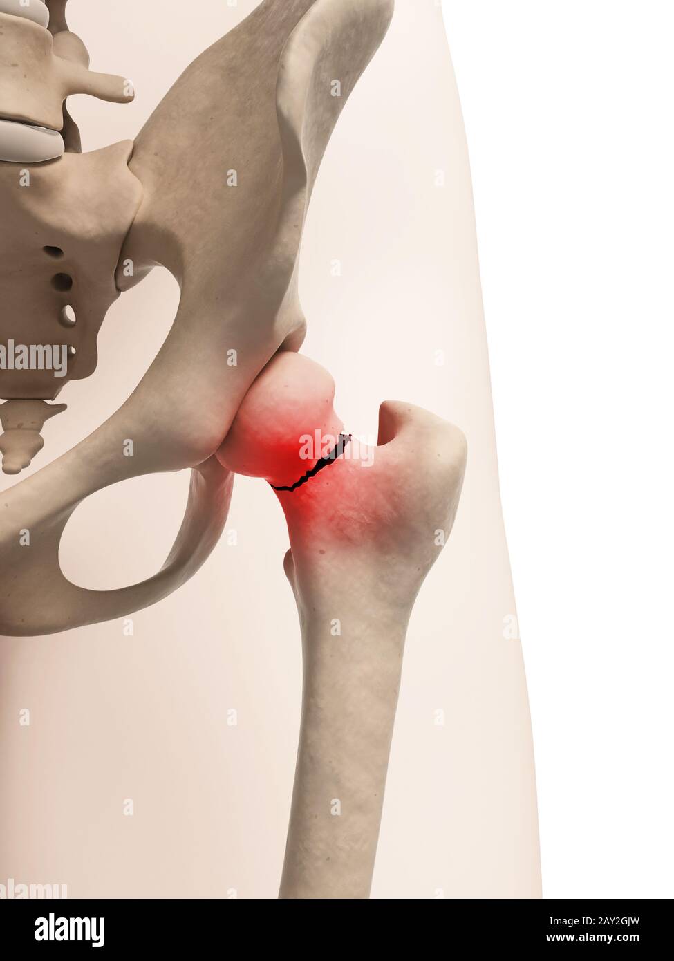 medizinische Illustration der gebrochenen Hüfte Stockfoto