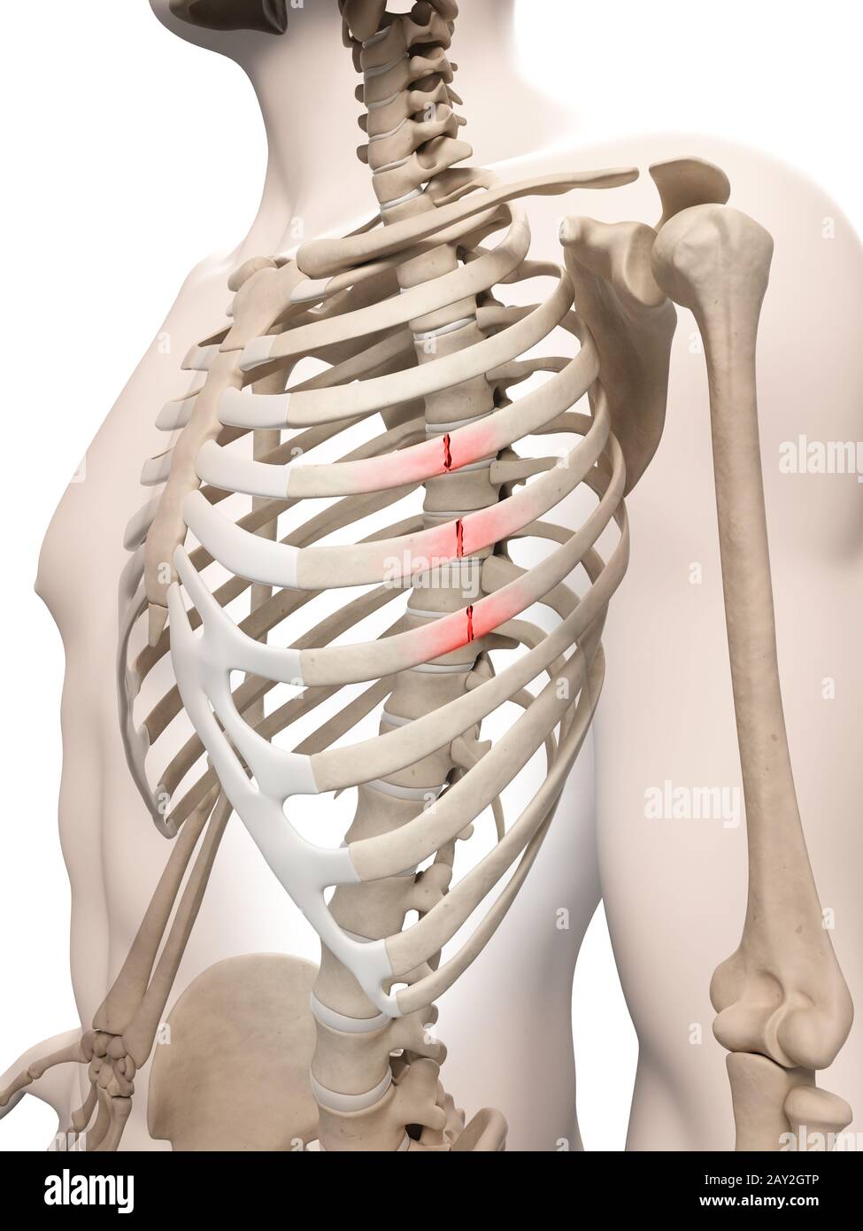 medizinische Illustration der gebrochenen Rippen Stockfoto