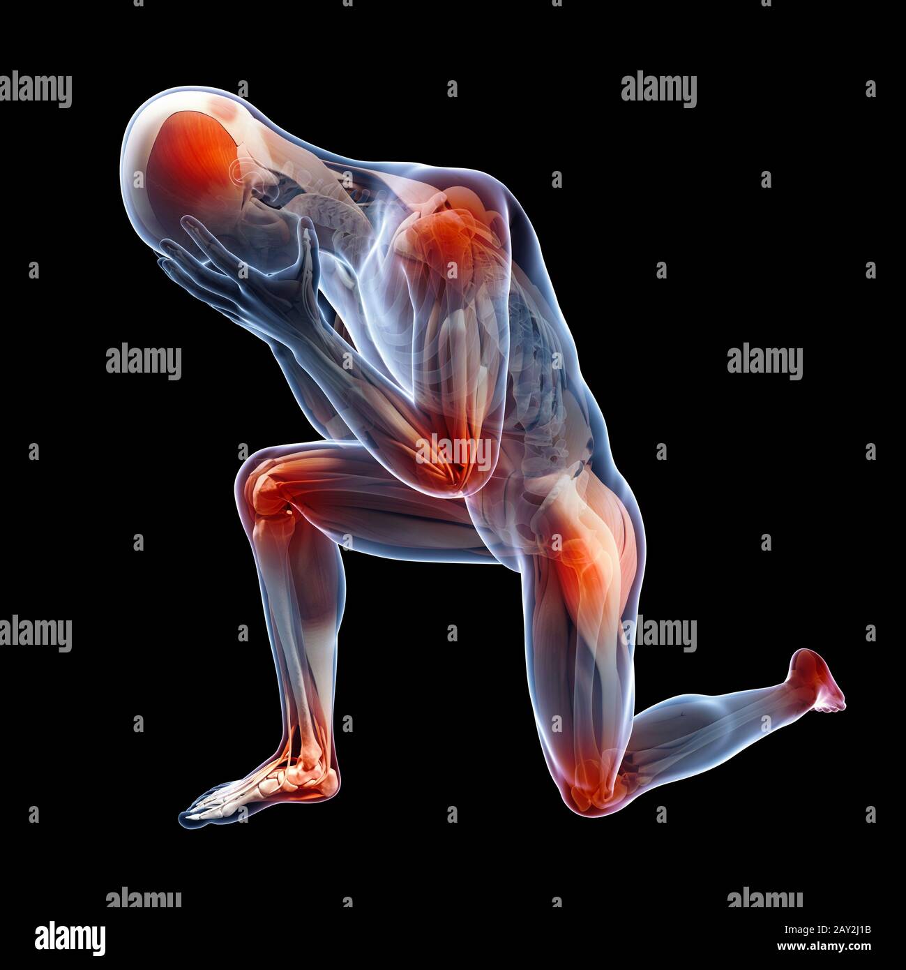 Medizinische Abbildung zeigt entzündete Stockfoto