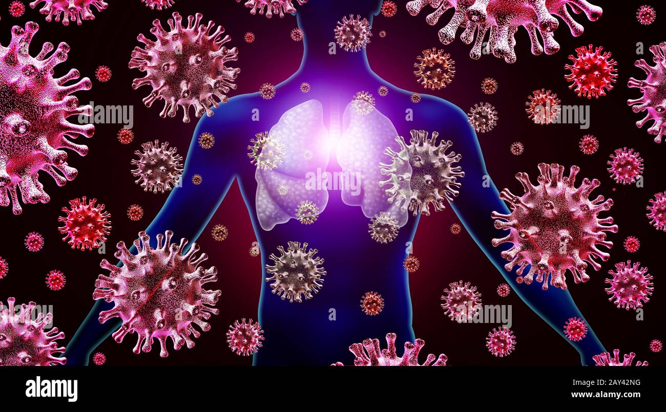 Atemvirus-Lungeninfektion und Influenza-Grippe-Ausbruch und Coronavirus oder Coronaviren als gefährliche Fälle von SARS als Pandemie oder Epidemie. Stockfoto