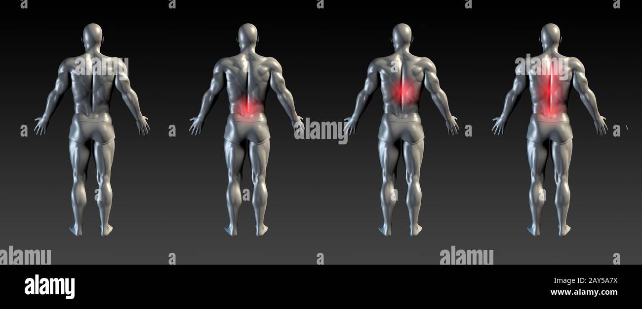 Verletzungen der Wirbelsäule Stockfoto