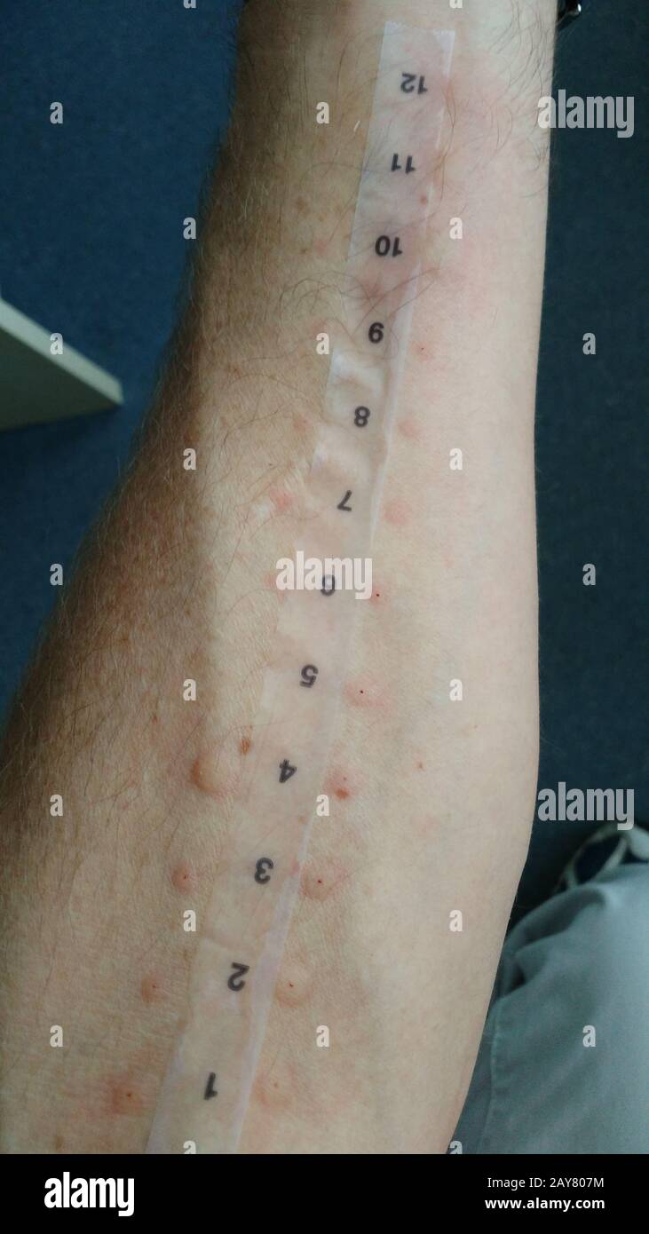 Der Allergietest am Unterarm weist Anzeichen für mehrere allergische Reaktionen auf Stockfoto
