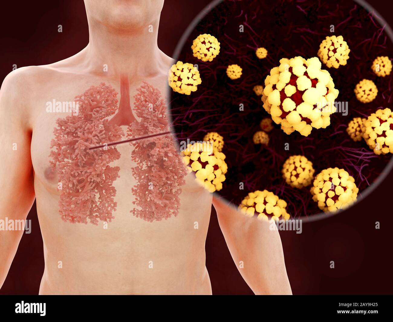 Infektion der Lunge mit Coronavirus, Abbildung Stockfoto