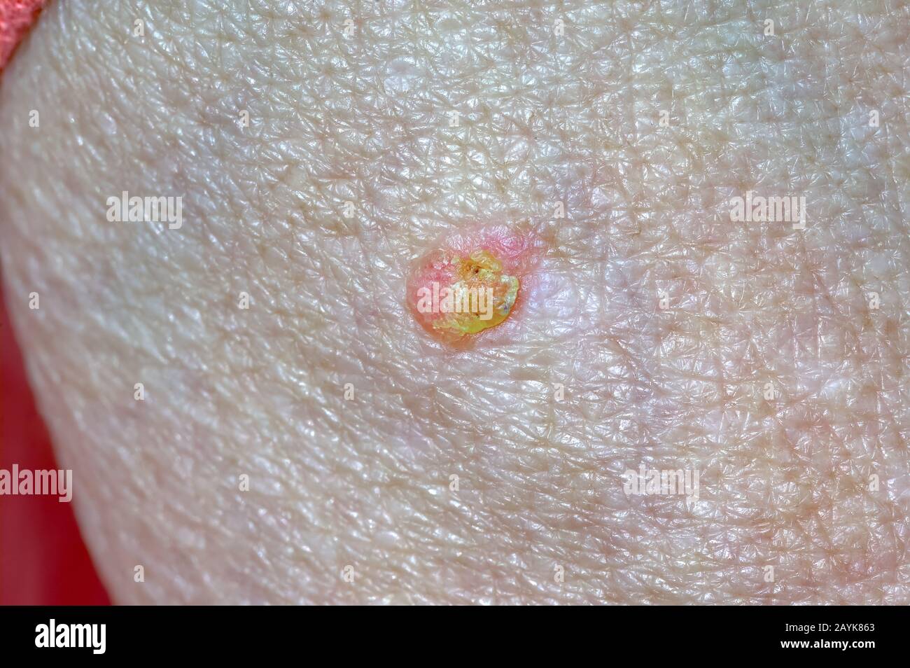 Solar keratosis Fotos und Bildmaterial in hoher Auflösung Alamy