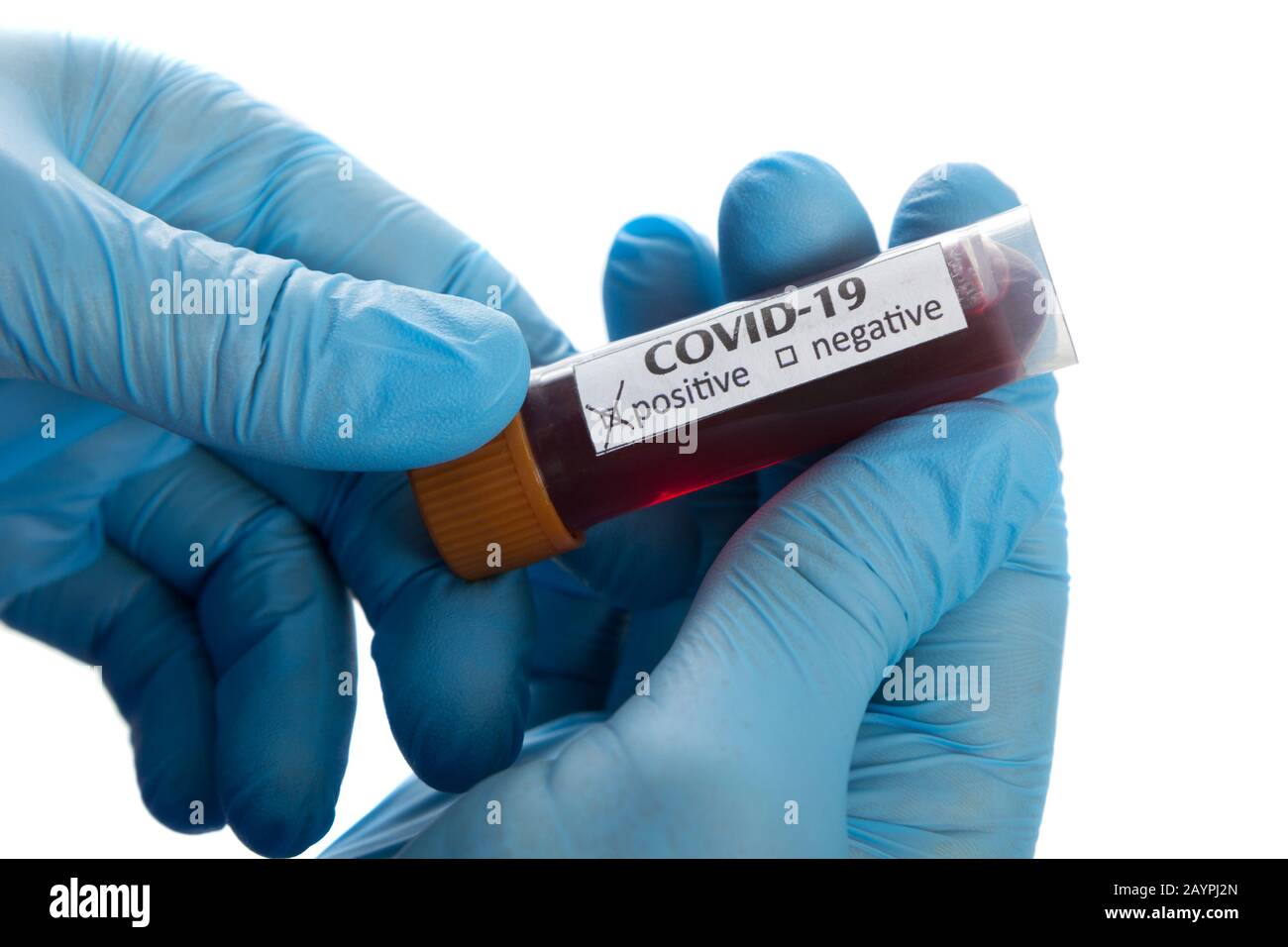 Coronavirus COVID-19 Blutprobe Stockfoto