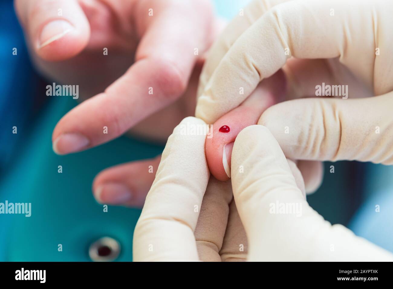 Krankenschwester drückt den Blutstropfen aus dem Finger des Patienten für den Diabetestest Stockfoto