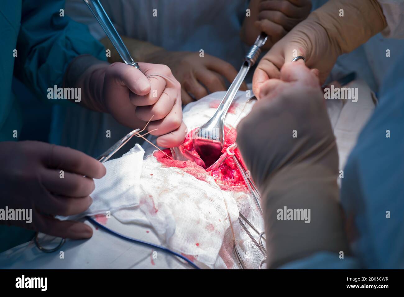 Ein Chirurg mit Assistenten, die in einem sterilen Operationssaal, ist auf die inneren Organe betrieben. Blau kalten OP-Leuchten. Die Hände des Chirurgen halten Sie die INSTRUME Stockfoto