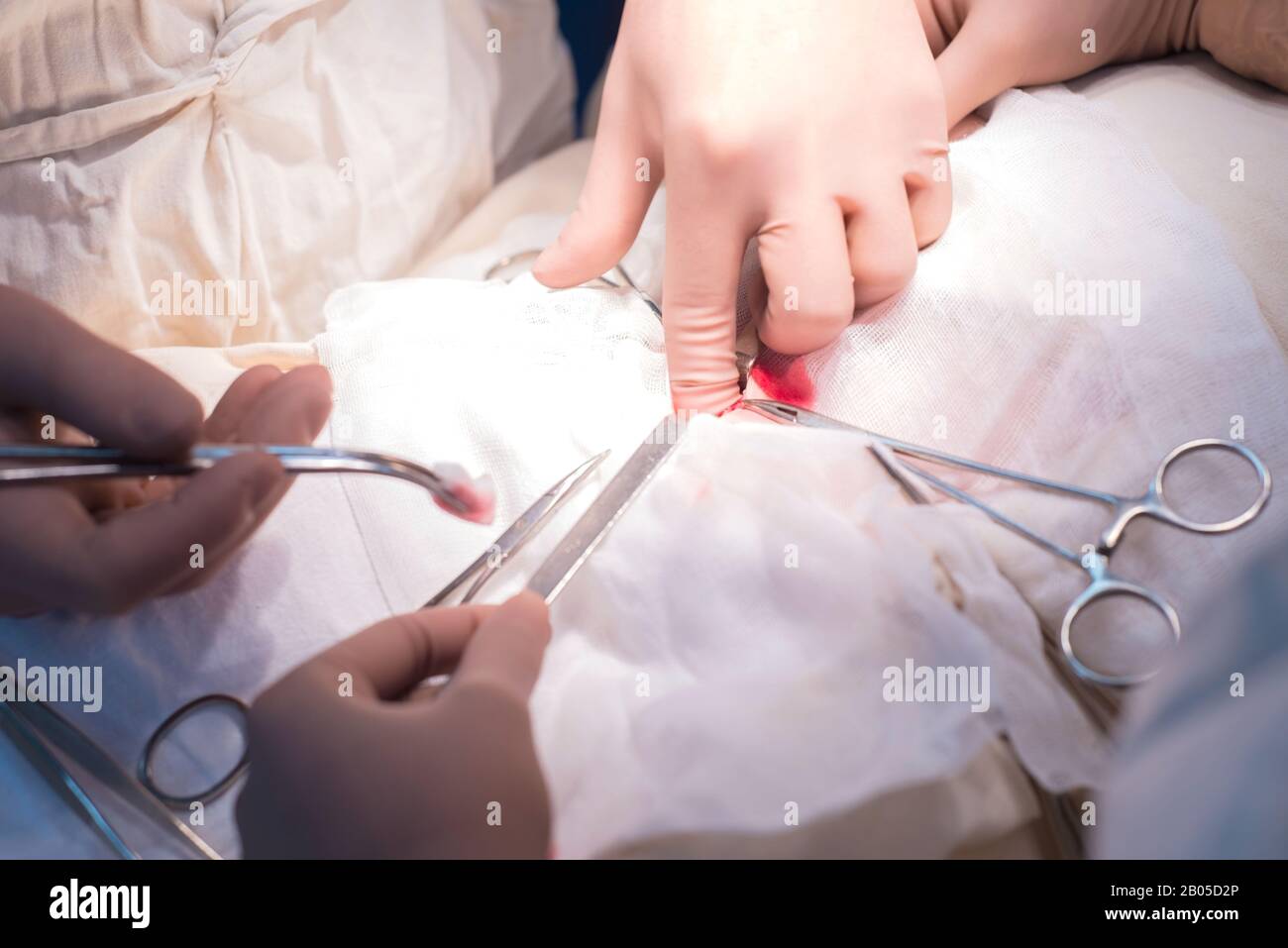 Der Chirurg und sein Assistent arbeiten, die in einem sterilen Op. Nahaufnahme der Hand einer pädiatrischen Chirurg. Phase der Operation für eine Urologische dise Stockfoto