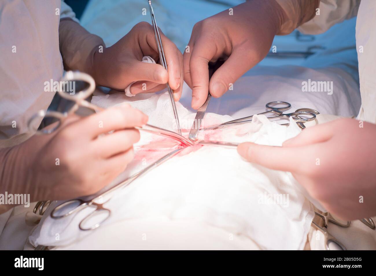 Die Hände des Chirurgen und Assistenten, Nahaufnahme, während der Operation. Sterile Op. Ärzte Werkzeuge in die Wunde an der Hand manipulieren. Pediat Stockfoto