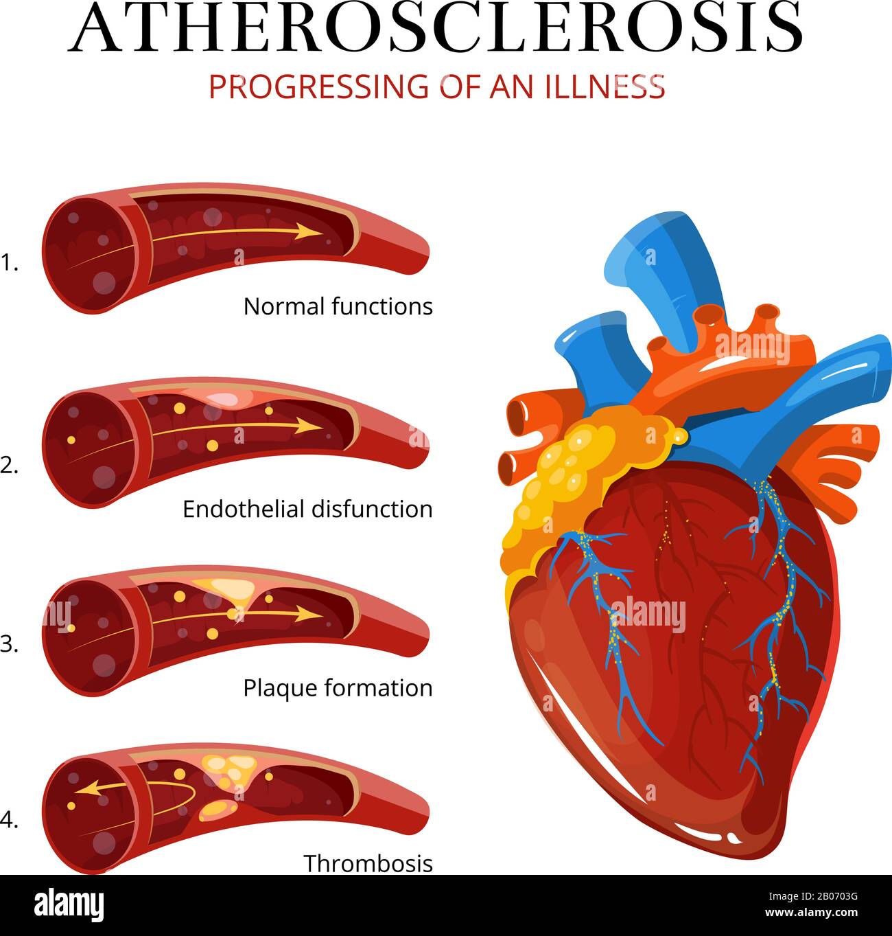 Atherosklerose, Blutgerinnselbildung. Vektormedizinische Illustration. Innenorgan, Thrombose und Endothelie Stock Vektor