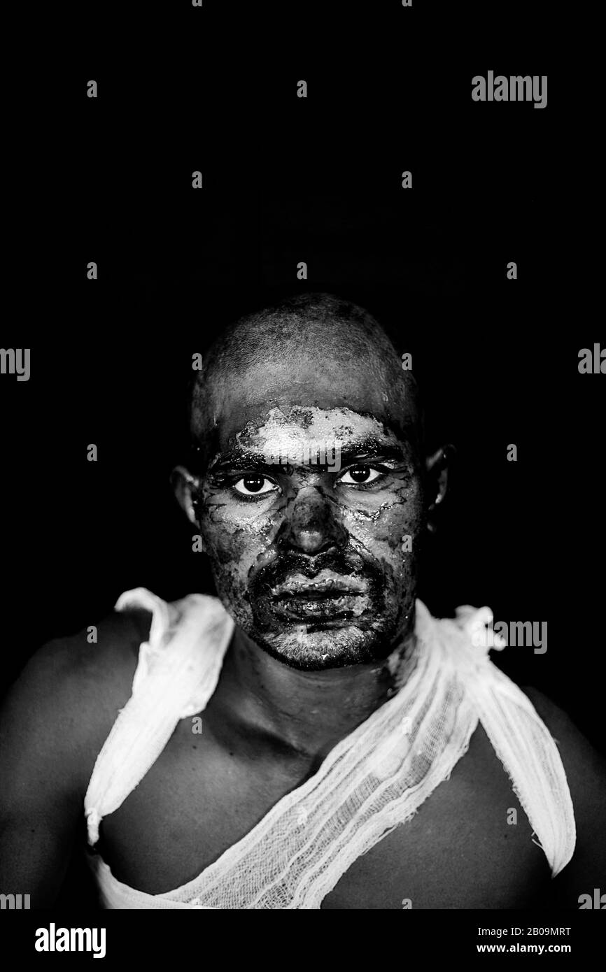 06. Dezember 2013, Alamgir Hossain (25), Busleiter. Er arbeitet als Leiter eines Interdistribusses. Er schlief um Mitternacht in den Bus am Busbahnhof Mawa. Misskrete warfen Benzinbombe in den Bus. Alamgir fühlte, dass er mit etwas im Schlaf schimpfte und dann wachte er auf und fand sich in einem brennenden Bus wieder. Mit seinem brennenden Körper sprang er aus dem Bus heraus. Zwanzig Prozent seines Körpers sind verbrannt. Sofort wurde er zur Behandlung in das nächste örtliche Krankenhaus gebracht, dann gab er am 08. Dezember in der Burn Unit des Dhaka Medical College Hospital zu. Stockfoto