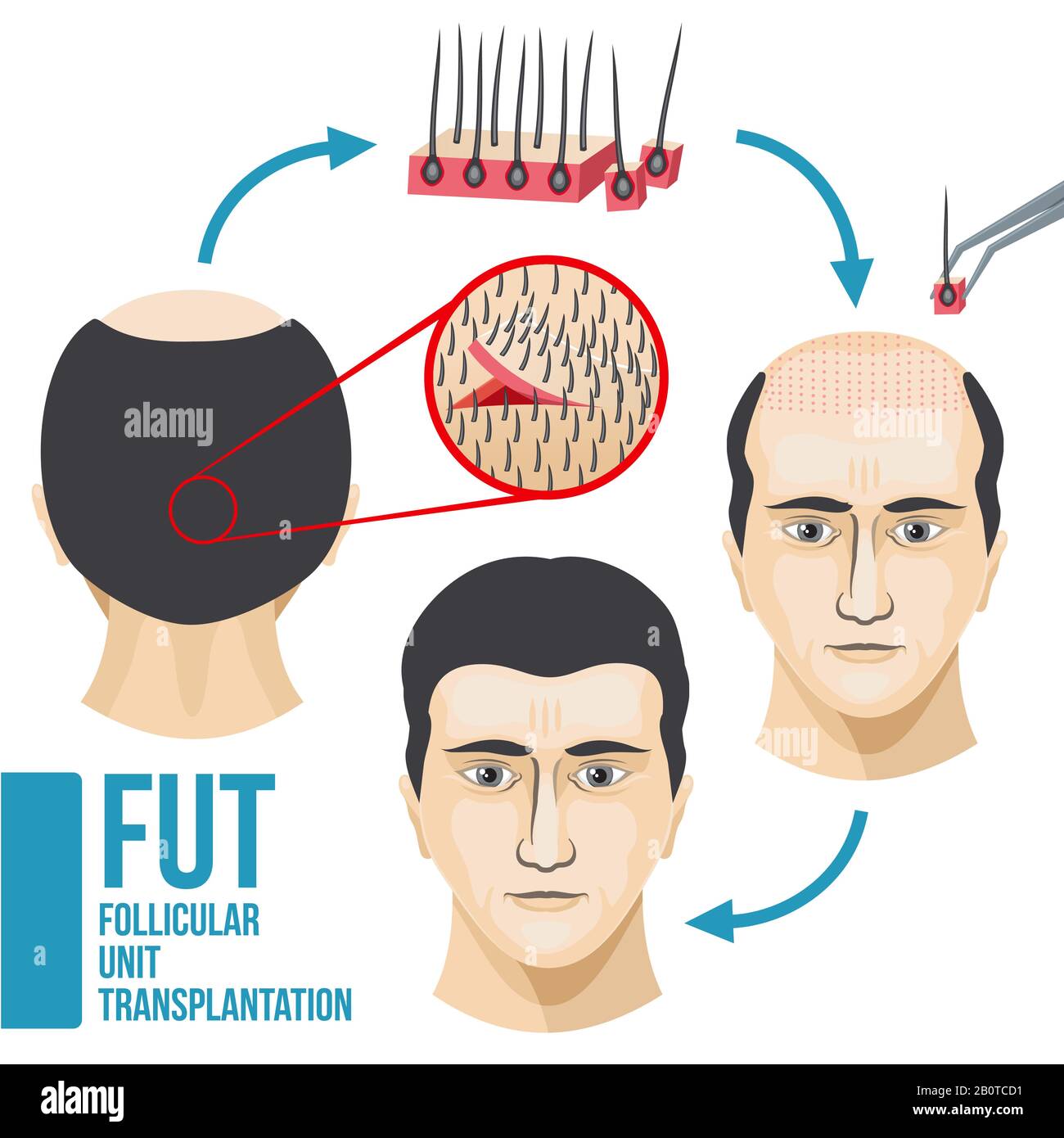Infografik zur Behandlung von Haarausfall bei Männern mit medizinischem Vektor. Darstellung von Krankheitshaaren und -Kahlheit, Wachstum und Transplantationshaaren Stock Vektor