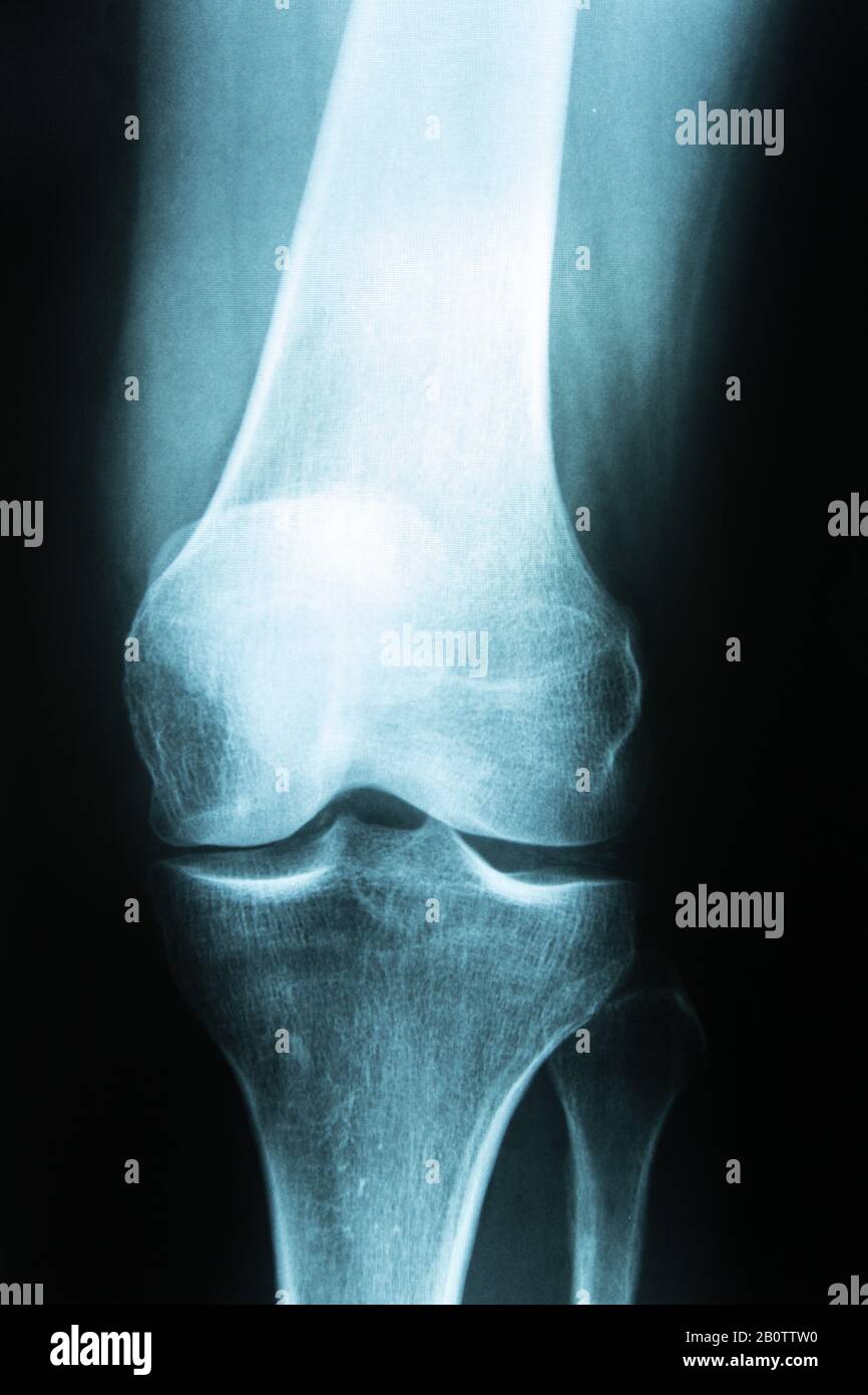 Röntgenaufnahme eines Kniefraoms einer Frau Stockfoto