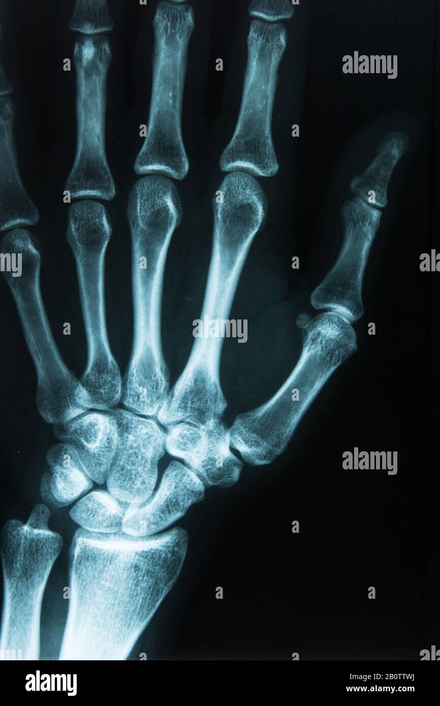 Röntgenaufnahme der Hand Stockfoto