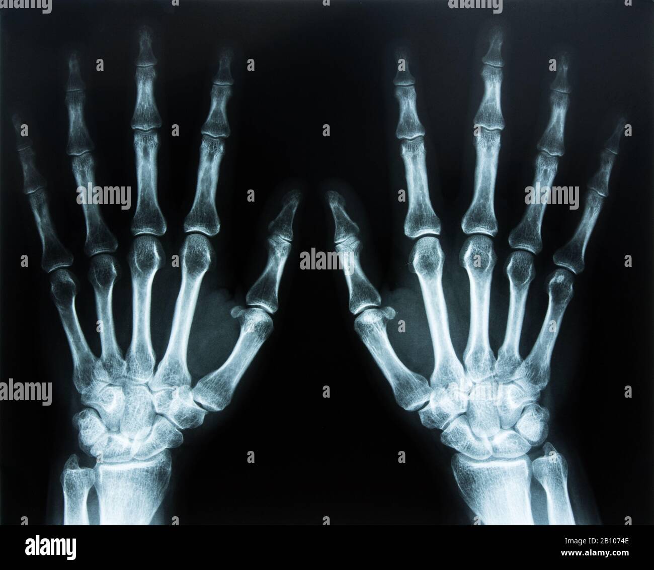 Röntgenaufnahme der Hand Stockfoto