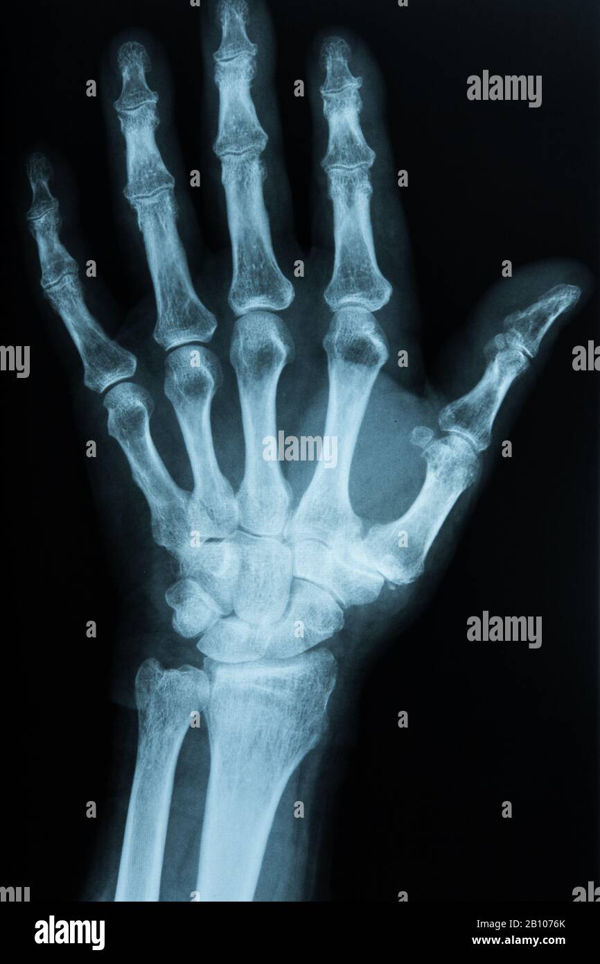 Röntgenaufnahme der Hand Stockfoto