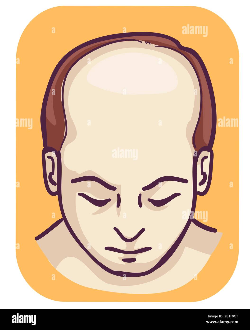 Abbildung eines Mannes mit Haarausfall oben, Haarausfall männlich Stockfoto