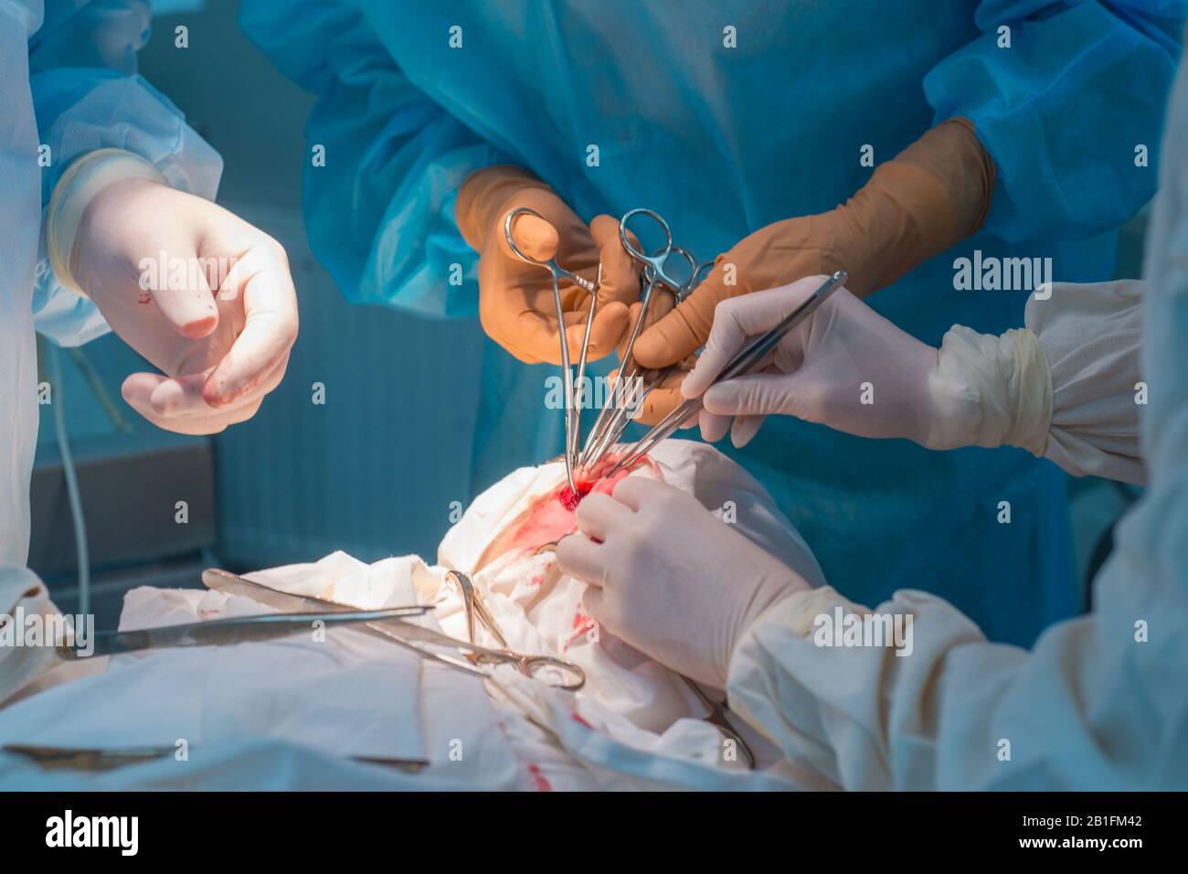 Nahaufnahme, die Hände von Kinderchirurgen und ein Assistent, der einen kleinen Patienten mit einer Hinter-Ohr-Lymphadenitis operiert. In einem sterilen Operationssaal. R Stockfoto